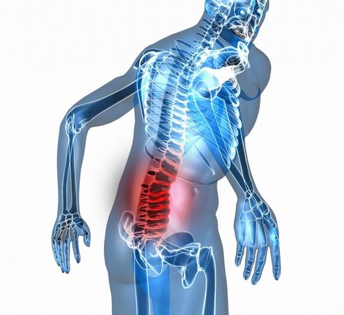 Triệu chứng và phương pháp giác hơi trị đau lưng hiệu quả