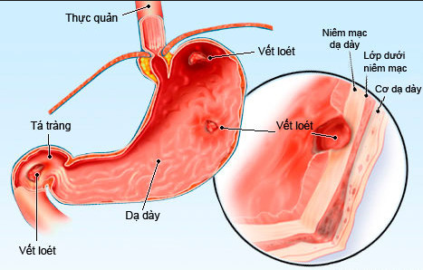 Viêm loét đường tiêu hóa là một trong những nguyên nhân gây đau lưng sau khi ăn
