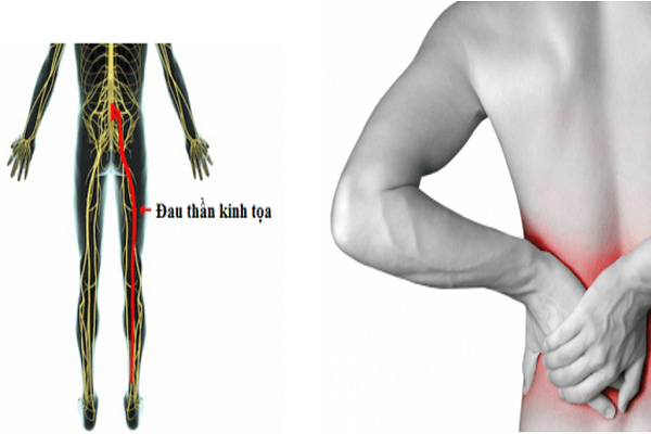 Đau dây thần kinh tọa cũng có thể gây ra những cơn đau vùng eo bên trái