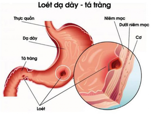 Loét dạ dày tá tràng cũng là lí do khiến bạn bị đầy hơi, khó tiêu