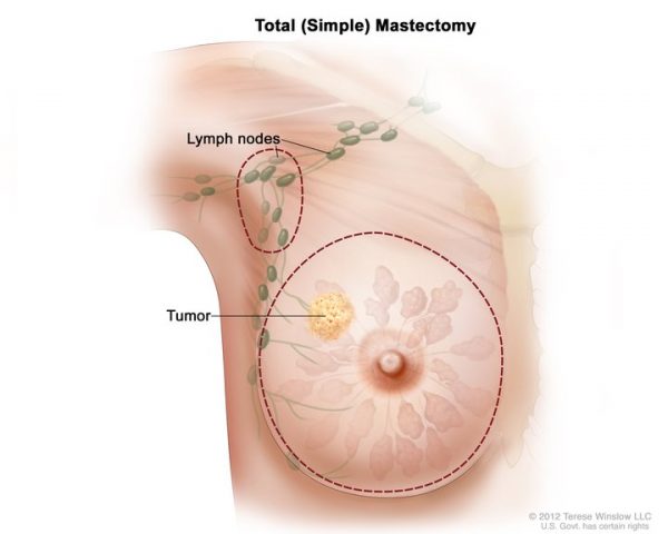 Điều trị u diệp thể giống như ung thư vú