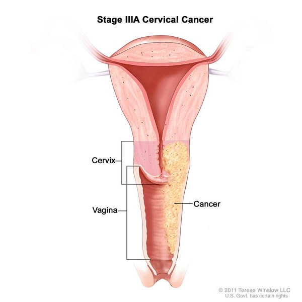 Ung thư cổ tử cung giai đoạn III