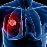 Điều trị ung thư phổi giai đoạn cuối như thế nào?