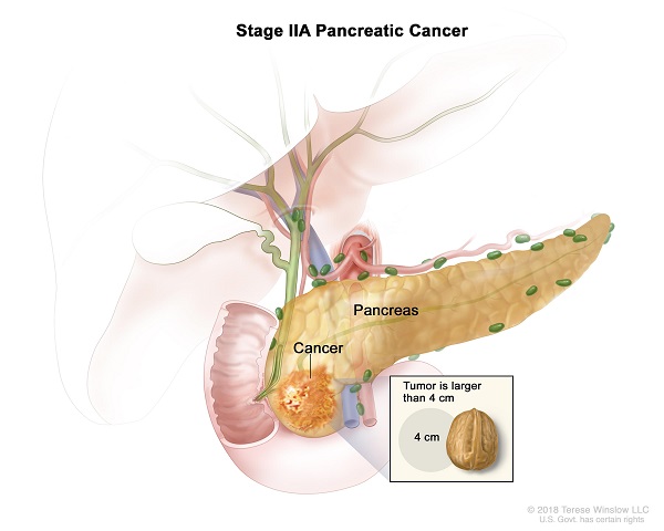 Ung thư tuyến tụy giai đoạn II