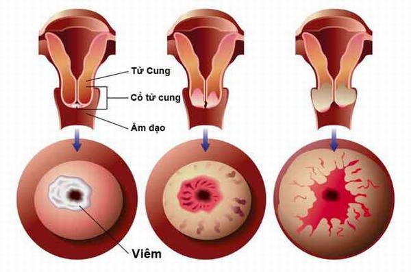 Viêm lộ tuyến cổ tử cung là tình trạng các tế bào ở bên trong cổ tử cung phát triển và xâm lấn ra bên ngoài cổ tử cung.