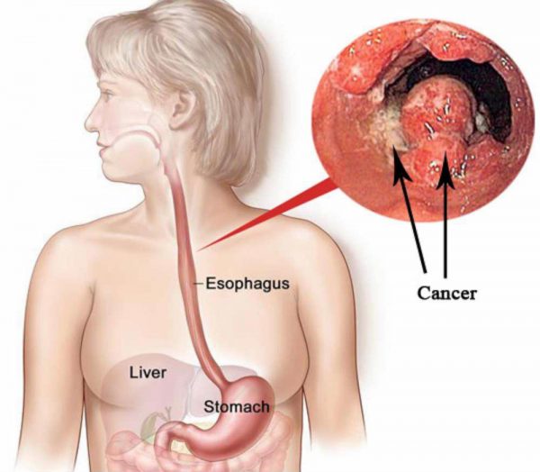 Ung thư thực quản ở người trẻ: Nhận diện, Điều trị và Tương lai