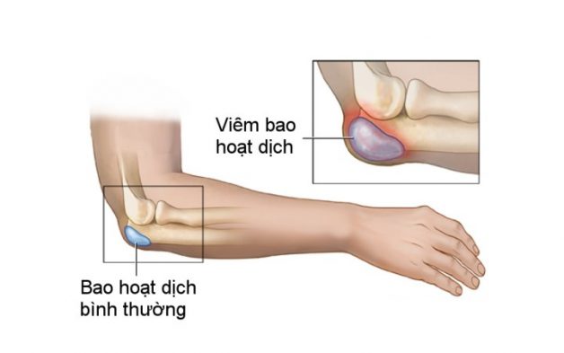 Bệnh đau khớp khuỷu tay có nguy hiểm không?