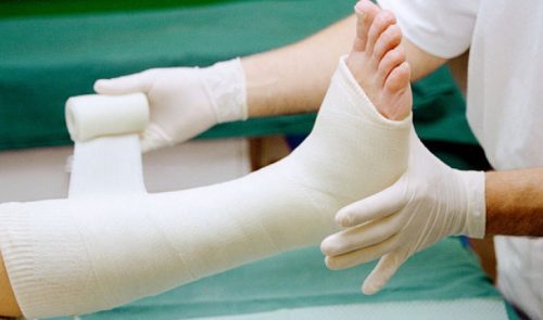 Gãy thân 2 xương cẳng chân thường xảy ra do lực nào tác động lên xương?
