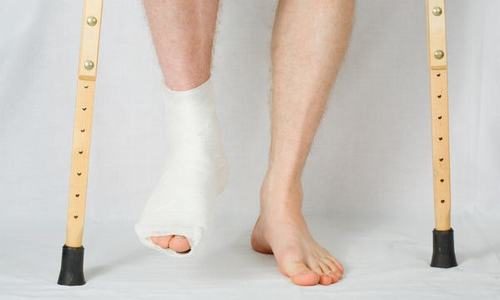 Gãy chân bao lâu đi lại được là thắc mắc của rất nhiều người Gãy chân bao lâu đi lại được là thắc mắc của rất nhiều người