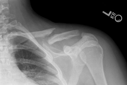 What are the benefits of using đai xương đòn số 8 for treating broken ribs?