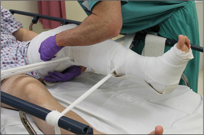 Bệnh nhân có thể được nắn chỉnh, bó bột khi bị gãy xương đùi