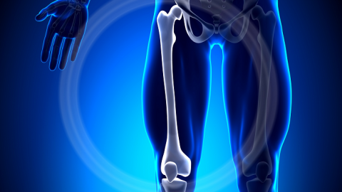 Gãy xương đùi: Triệu chứng nhận biết và cách điều trị