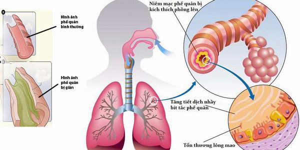 Giãn phế quản là bệnh lý thường gặp ở đường hô hấp, rất nguy hiểm