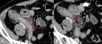 Hình ảnh CT viêm ruột thừa | TCI Hospital