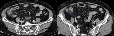 Hình ảnh CT viêm ruột thừa | TCI Hospital