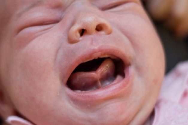 Dính thắng lưỡi khiến trẻ gặp khó khăn khi bú mẹ