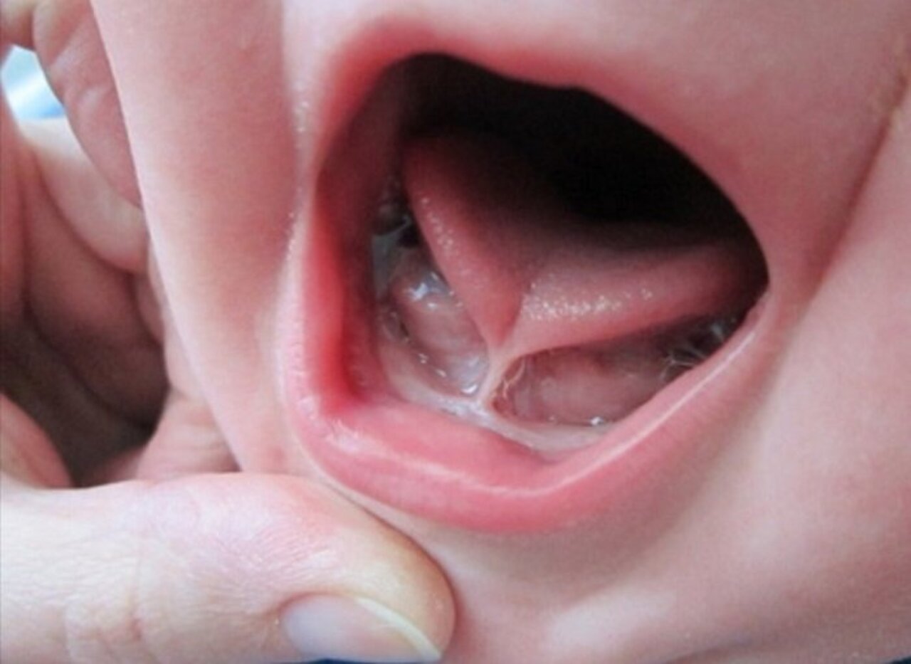 Triệu chứng của trẻ bị viêm họng là gì?
