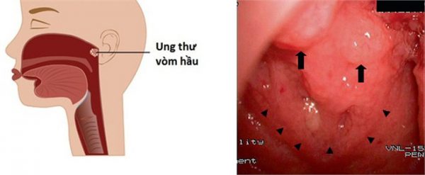 Hình ảnh ung thư vòm họng | TCI Hospital