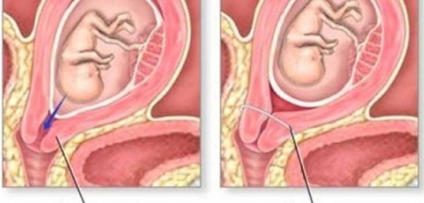  Đối tượng có nguy cơ cao bị hở eo tử cung 