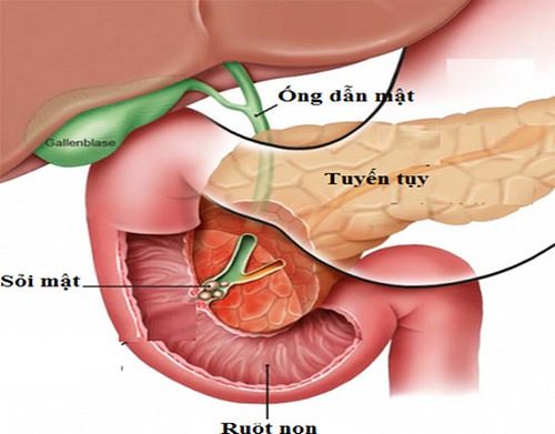 Khám và điều trị viêm tụy | TCI Hospital