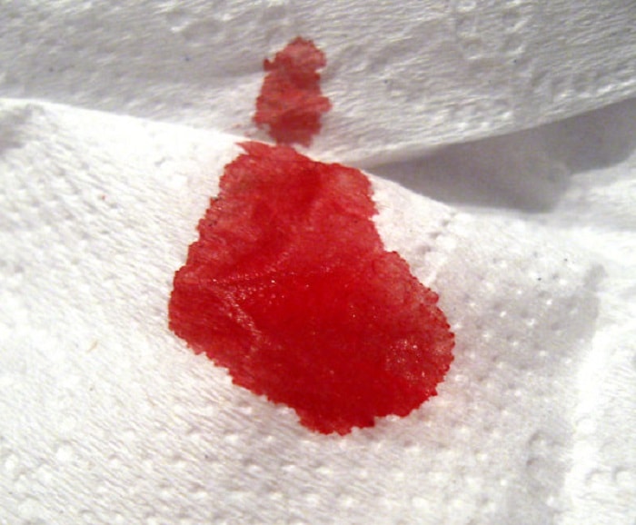 Máu kinh nguyệt có chứa dịch nhầy màu đỏ và không đông, trong khi máu sảy thai thường có những cục máu và có thể đông lại. Còn những điểm khác biệt nào?
