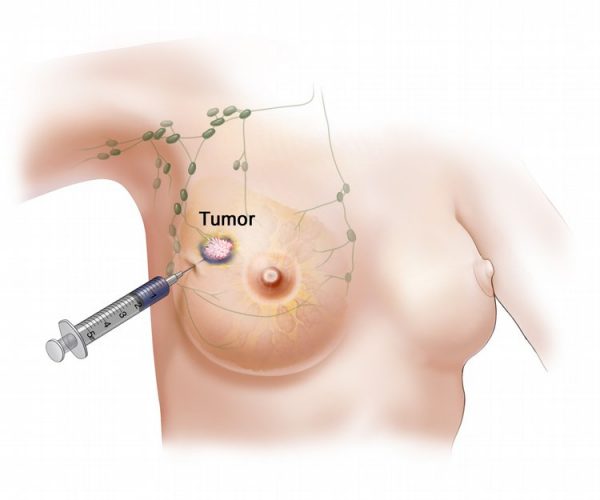 Các triệu chứng của khối u diệp thể khá giống với u xơ vú