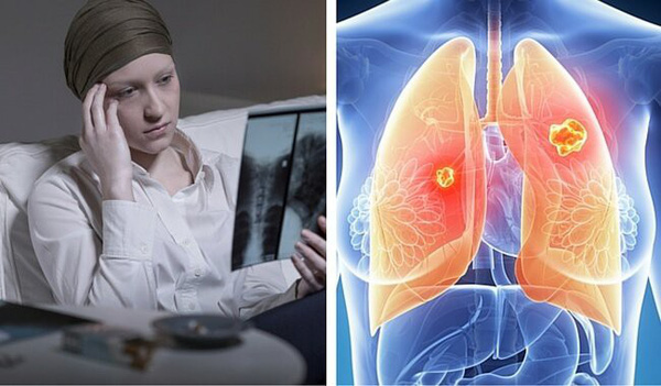 Ung thư phổi không loại trừ nữ giới trẻ, người không hút thuốc