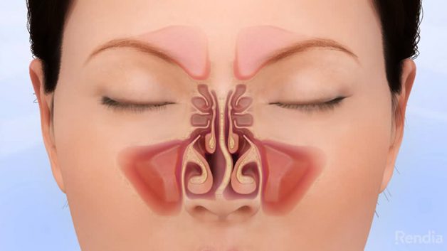 Vì sao cần điều trị sớm lệch vách ngăn mũi?