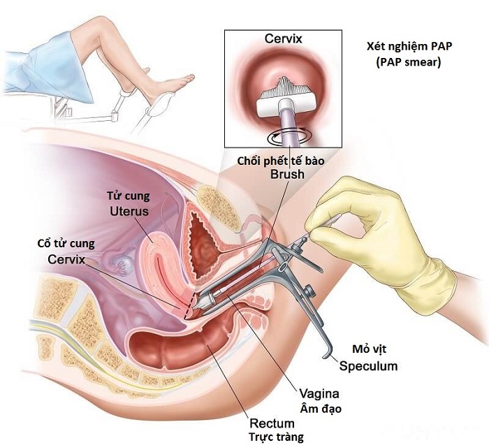 Xét nghiệm PAP-smear sàng lọc phát hiện sớm ung thư cổ tử cung