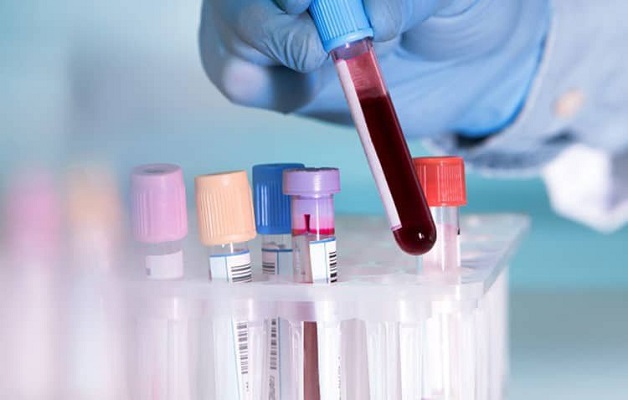 LYM trong xét nghiệm máu là gì? Cách đọc chỉ số LYM