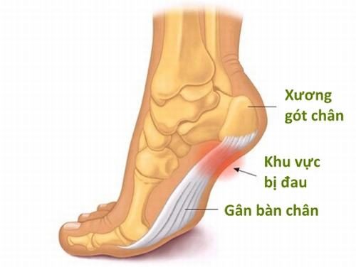 Một số Vị Trí Viêm Cơ Chân thường gặp nhất mà BẠN NÊN biết 3 Một số vị trí viêm cơ chân thường gặp