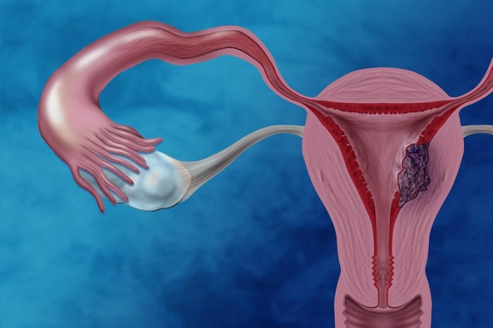 Mỗi loại u nang sẽ ảnh hưởng khác nhau đến buồng trứng