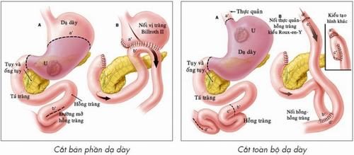 Mổ dạ dày nên ăn gì? Hướng dẫn chi tiết cho người bệnh sau phẫu thuật