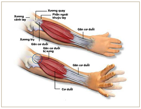 Thông Tin Về Nhức Xương Cánh Tay