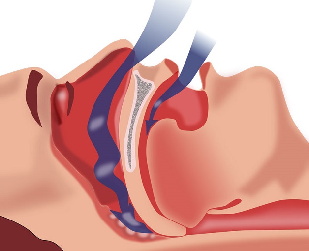 Ngủ dậy bị đau nửa đầu bên trái: Nguyên nhân và cách điều trị hiệu quả