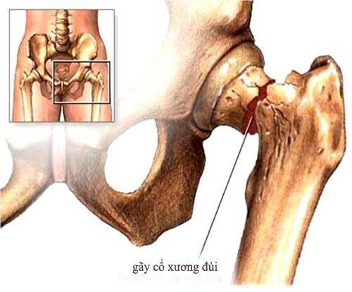 Tiến triển của hoại tử vô khuẩn khớp háng như thế nào nếu không được điều trị?