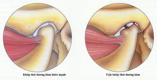 nguyen-nhan-gay-trat-khop-thai-duong-ham-1