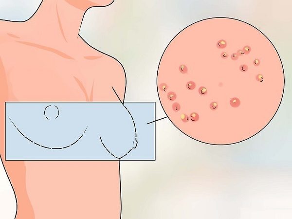 Ngực nổi mụn đỏ có thể là dấu hiệu của vấn đề nội tiết không?
