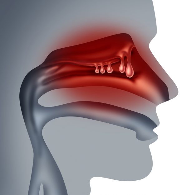 Polyp mũi xoang là hậu quả do việc viêm nhiễm trong thời gian gian dài