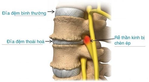 Nguyên nhân và triệu chứng gãy xẹp – lún đốt sống