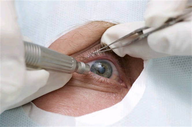 Nếu người bệnh bị đục thủy tinh thể cả hai mắt, bác sĩ sẽ không tiến hành phẫu thuật hai mắt cùng lúc mà mỗi mắt sẽ được phẫu thuật ở hai thời điểm khác nhau.