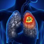 Những câu hỏi thường gặp về ung thư phổi