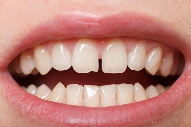 Người có hàm răng có nhiều khe hở lớn với tổng khoảng cách khoảng 6mm/hàm không phù hợp để thực hiện niềng răng trong suốt Zenyum.