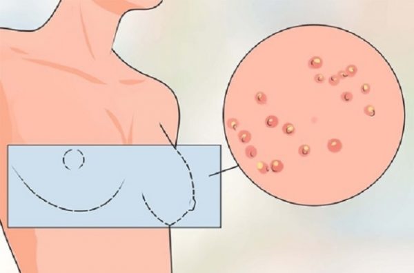 Nổi mụn xung quanh tuyến vú xuất phát từ nhiều nguyên nhân, có thể bắt nguồn từ ung thư vú