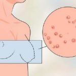 Nổi mụn xung quanh tuyến vú có phải ung thư không?