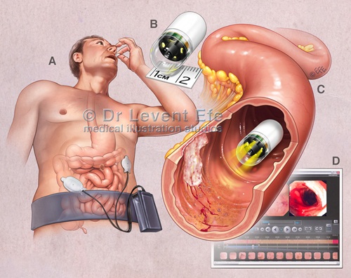Đây là phương pháp có độ chính xác cao và không gây đau cho người bệnh. nội soi dạ dày bằng viên nang