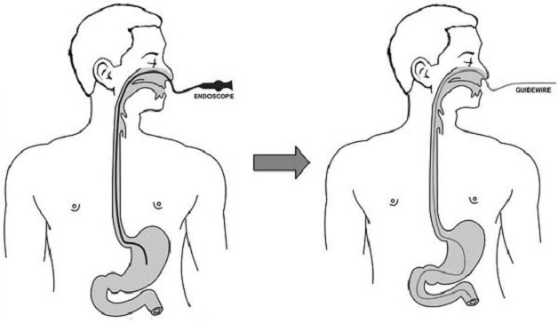 nội soi tiêu hóa bằng ống soi mềm đường mũi