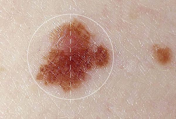 Đường kính, đường viền, độ lồi của nốt ruồi khác thường cũng cảnh báo dấu hiệu ung thư da 
