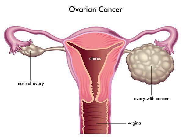Ung thư buồng trứng là bệnh ung thư phụ khoa đặc biệt nguy hiểm