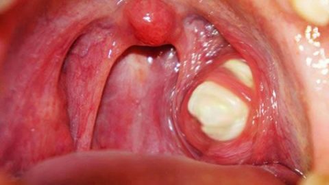 Phân biệt viêm amidan có mủ và ung thư vòm họng
